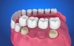 Drawing of dental bridge