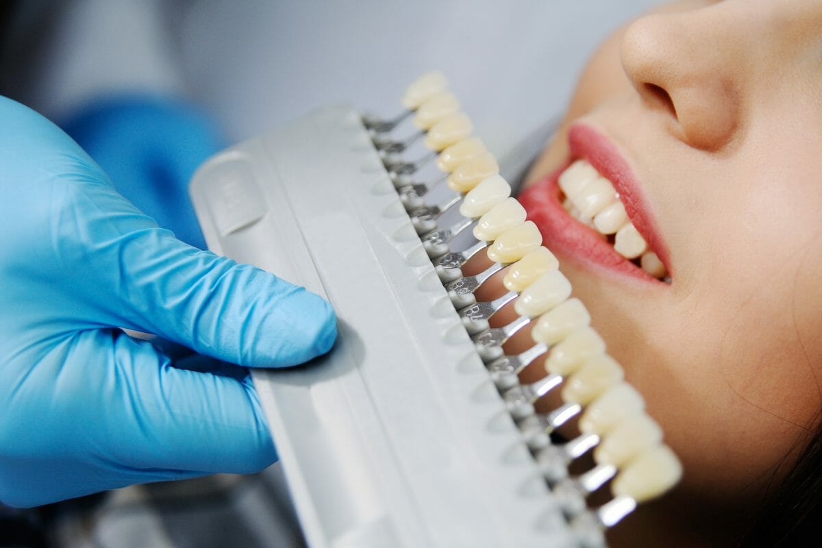 cerec crowns cerec crowns
