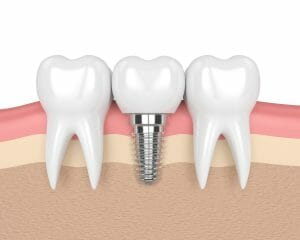 cross section of dental implant