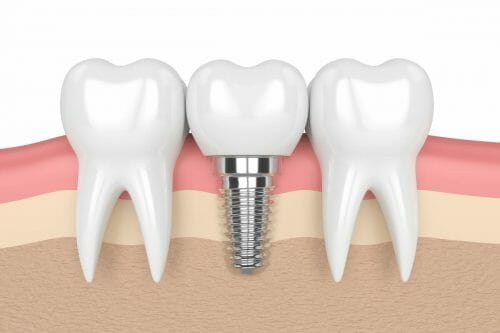 dental implant cross section
