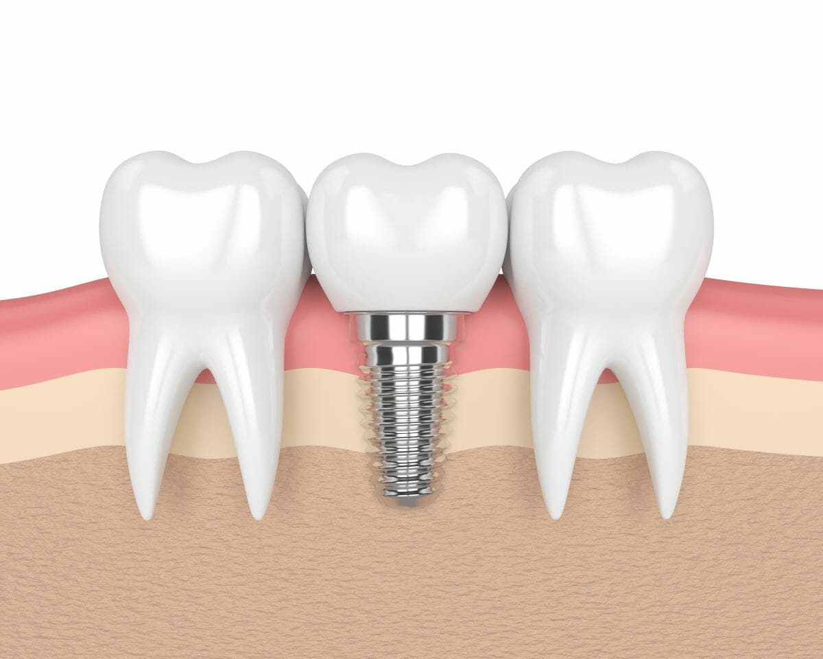 Dental Implant Provider in Lilitz Hicks Family Dentistry