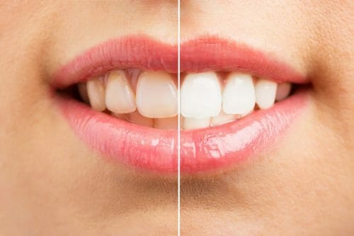 side by side of before and after whitening